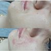 Коррекция объёма кожи филлером Belotero Soft в технике бланшинг